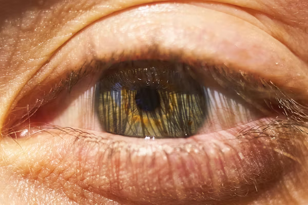 Myopia